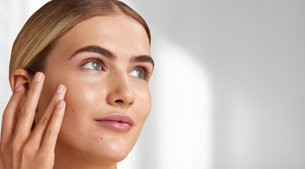 How To Look After Acne Prone Skin