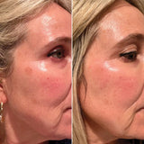 Metamorphosis | Age Spot | Pigmentation Correction Skincare Treatment