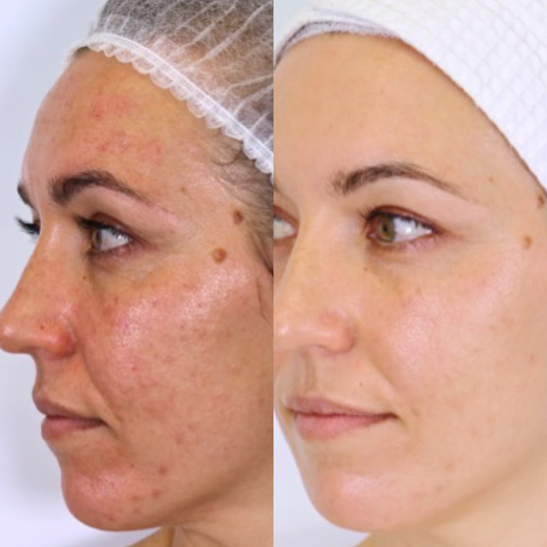 VanessaMeganNaturaceuticalSkincare_Results_Jody_Pigmentation